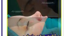 جراحی بینی در کرمان