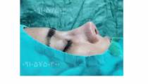 جراحی بینی فانتزی در بندر عباس