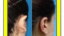 جراحی زیبایی گوش در گرگان