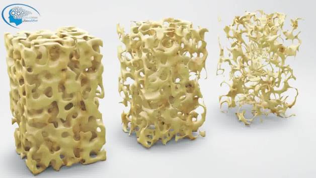 درمان پوکی استخوان : پیشگیری و درمان پوکی استخوان با قدرت مغز ناخودآگاه