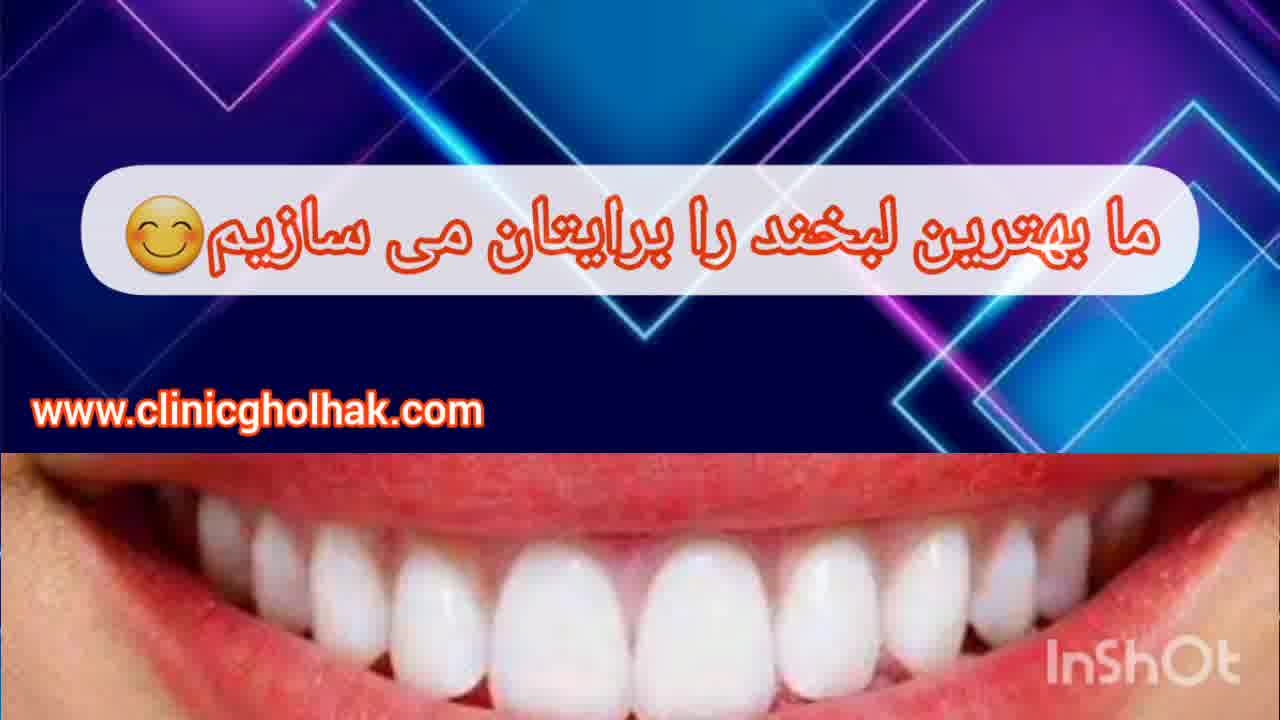 لمینت دندان در کلینیک دندانپزشکی قلهک