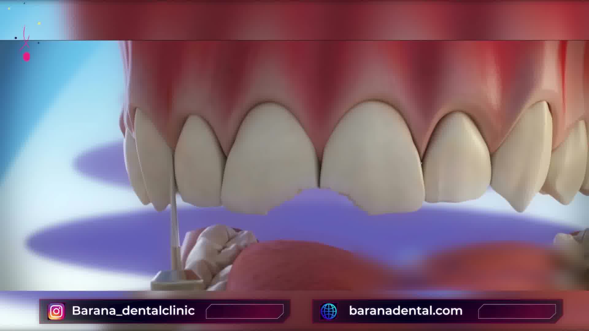 چگونگی اجرای لمینت دندان