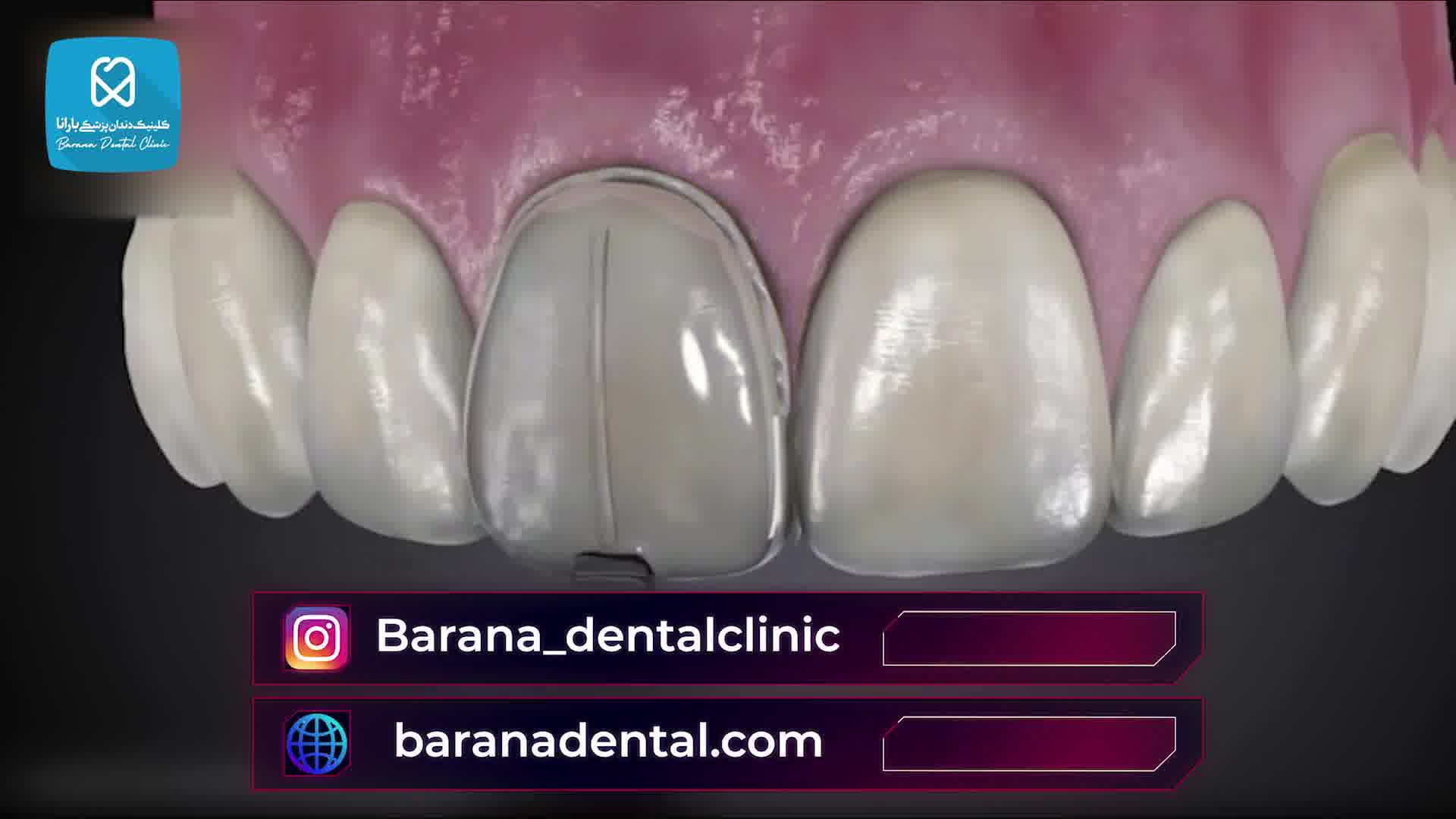 چگونگی ترمیم ونیر کامپوزیت دندان شکسته جلو